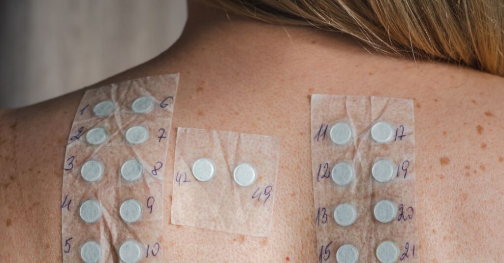 Patient getting an allergy patch test done on her back.