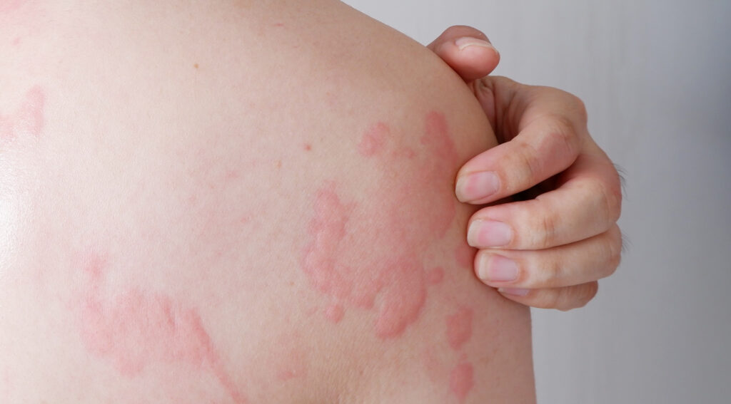A person with hives on their back